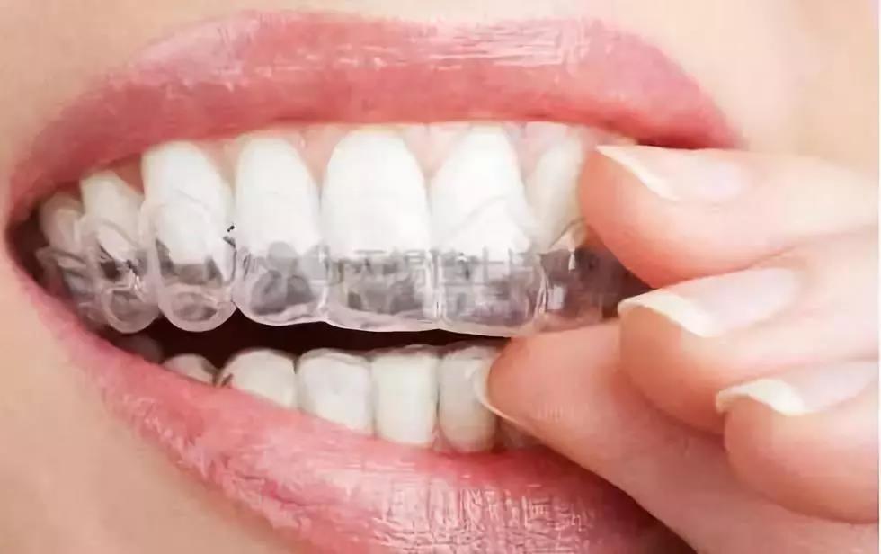 为什么正畸能改变脸型?牙套脸究竟是好还是坏?-津云app