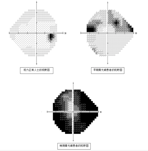 管状视野的患者,有人常常能保存中心视力,但是周边视野完全缺损,在