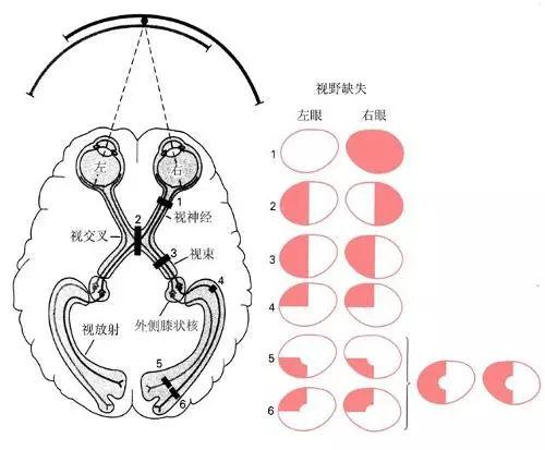 鼻侧视野缺损图片图片